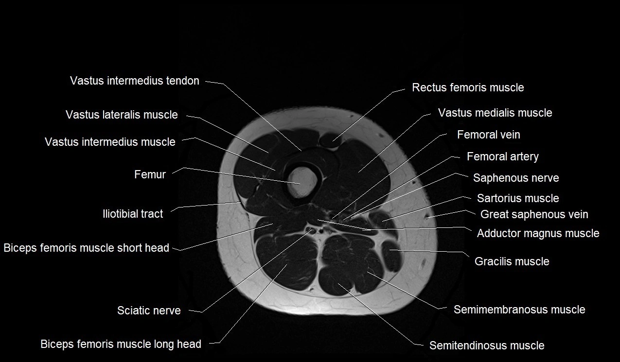 MRI thigh cross sectional anatomy image 41.webp